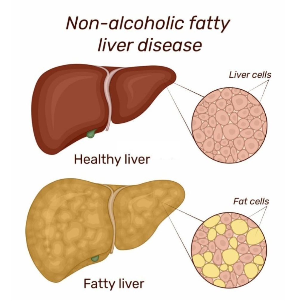 Non Alcoholic Fatty Liver Disease Solution By Julissa Clay FreshDocTor non-alcoholic-fatty-liver-disease-solution-by-julissa-clay-freshdoctor