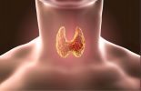 The Hypothyroidism Solution: A Comprehensive Guide