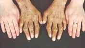 Does Hemochromatosis Help Manage Iron Levels?