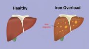 Ironbound: A Comprehensive Guide to Hemochromatosis and Iron Overload Management