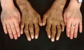 Ironbound: A Comprehensive Guide to Hemochromatosis and Iron Overload Management