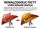 Non-Alcoholic Fatty Liver Disease Solution by Julissa Clay