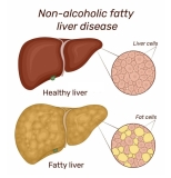 Non-Alcoholic Fatty Liver Disease Solution by Julissa Clay