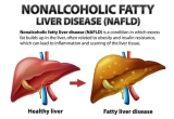 Top 5 benefits of using NAFLD Solution for fatty liver