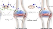 Top Benefits of Joint Genesis for Joint Pain Relief
